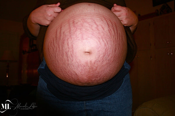 Pregnancy and stretch marks - ML Delicate Beauty