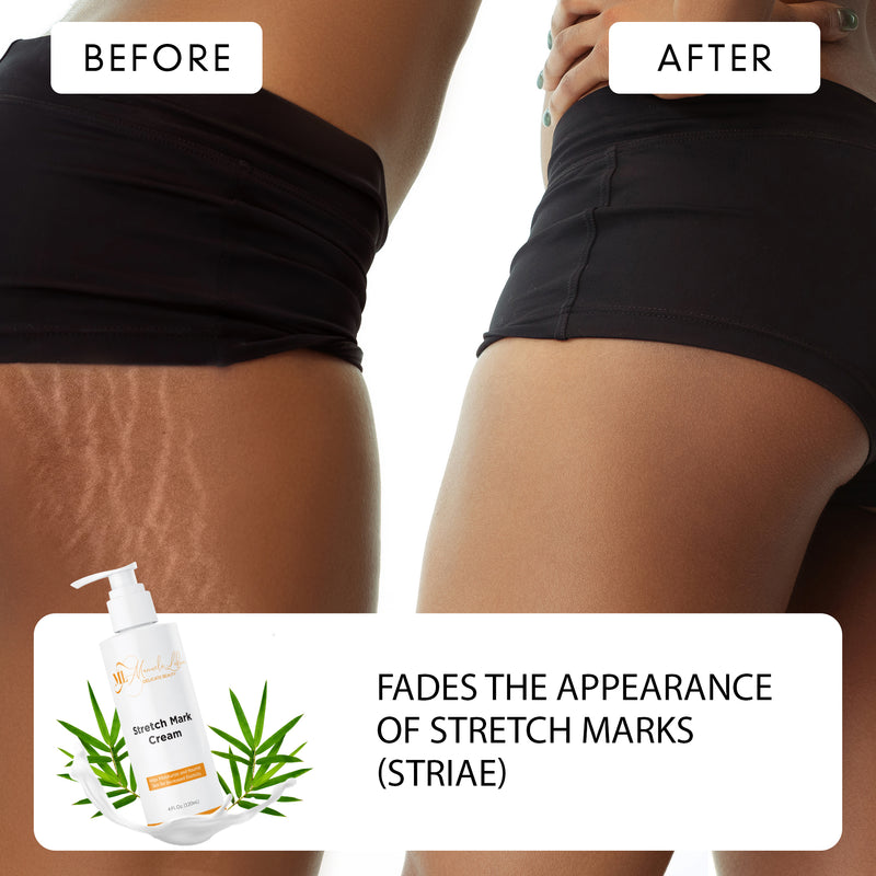 Before and after body and legs stretch marks 