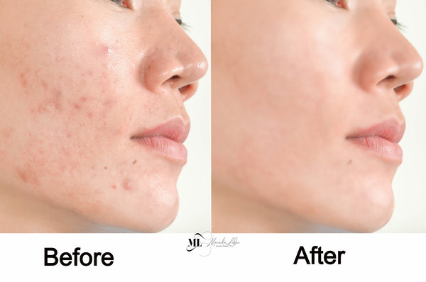 Acne free skin | ML Delicate Beauty