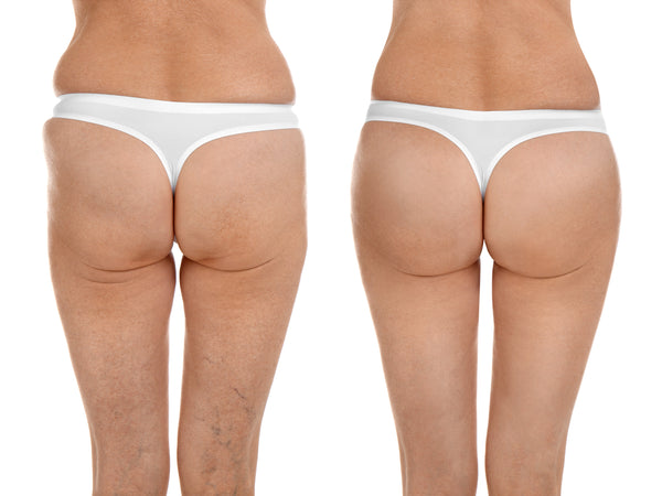 Stretch Mark cream for buttocks | ML Delicate Beauty